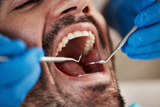 Best Emergency Dentist for Lost Fillings or Crowns in Mcadenville, NC
